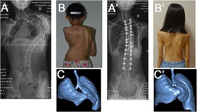 Pulmonary Recovery Following Corrective Surgery in Adult Patients With Severe Scoliosis: A Minimum of Five-Year Follow-Up